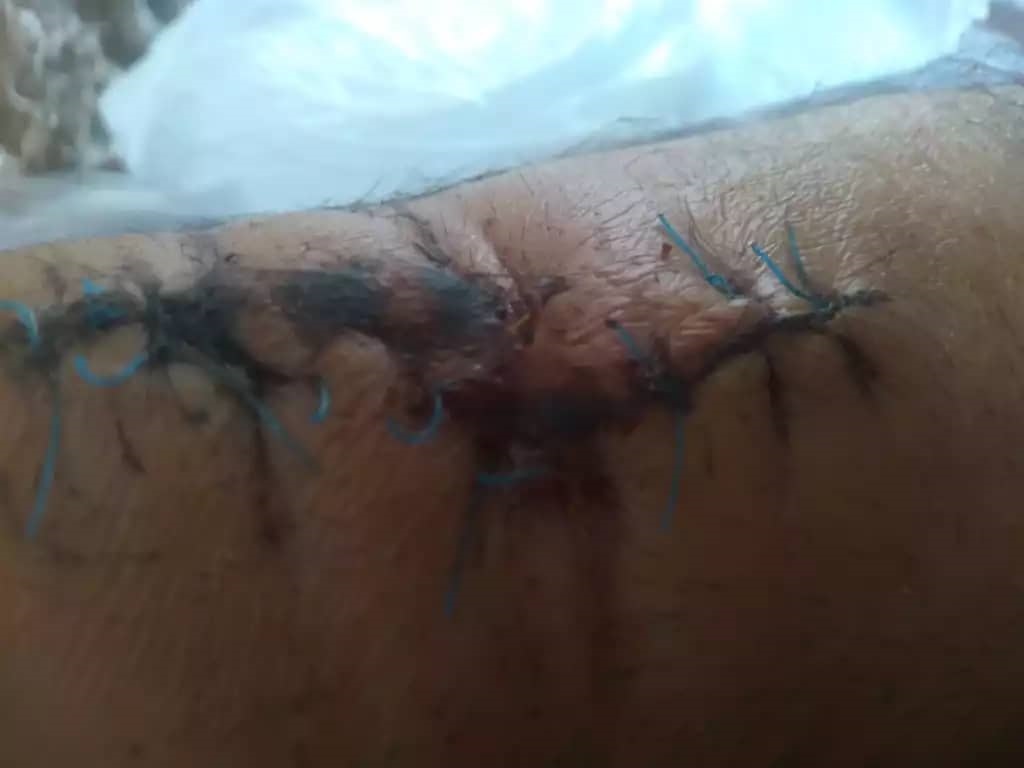 دست زخمی میرویس مهاجر اخراج شده از ایران